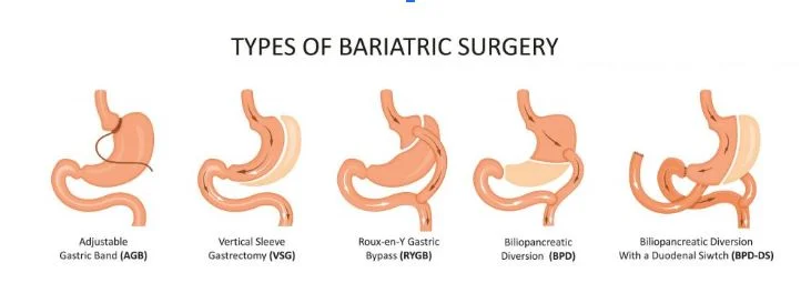 Types of bariatric surgery