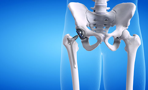 Hip Replacement Surgery: Patient Eligibility, Procedure Steps & Post-Op Recovery