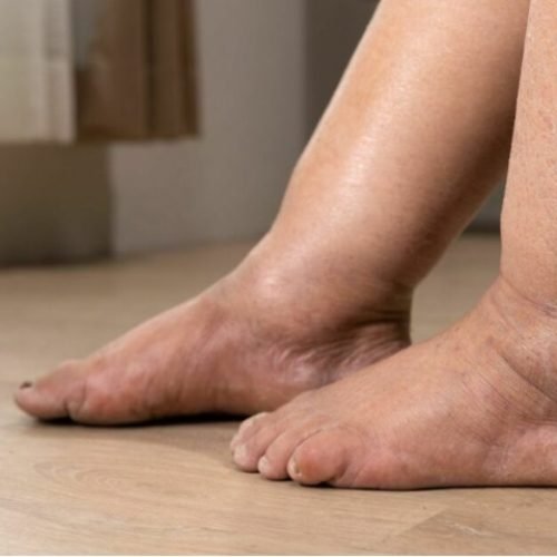 How to Reduce Swelling (Edema) Caused by Fluid Retention