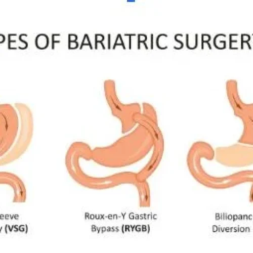 The Four Types of Bariatric Surgery: Understanding Their Key Differences