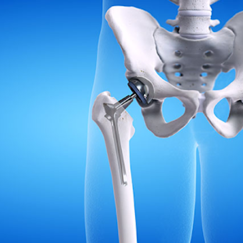Hip Replacement Surgery: Patient Eligibility, Procedure Steps & Post-Op Recovery